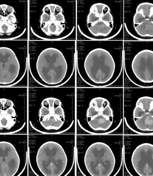 		 Brain scans of a six-year-old girl with medulloblastoma
	