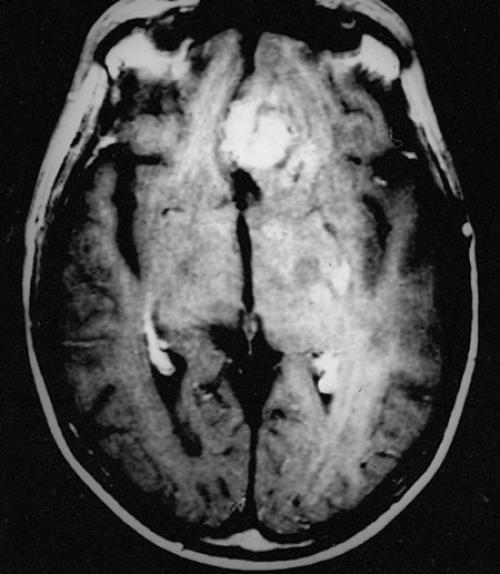 		 Scan of a glioblastoma brain tumor
	