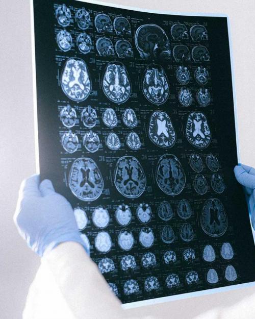 Brain scan images held by a doctor
