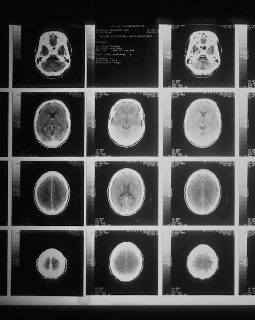 		Grid of 20 black and white images of an oblong shape: a brain seen from above
	
