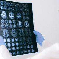 Brain scan images held by a doctor