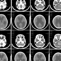  Brain scans of a six-year-old girl with medulloblastoma