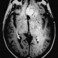  Scan of a glioblastoma brain tumor