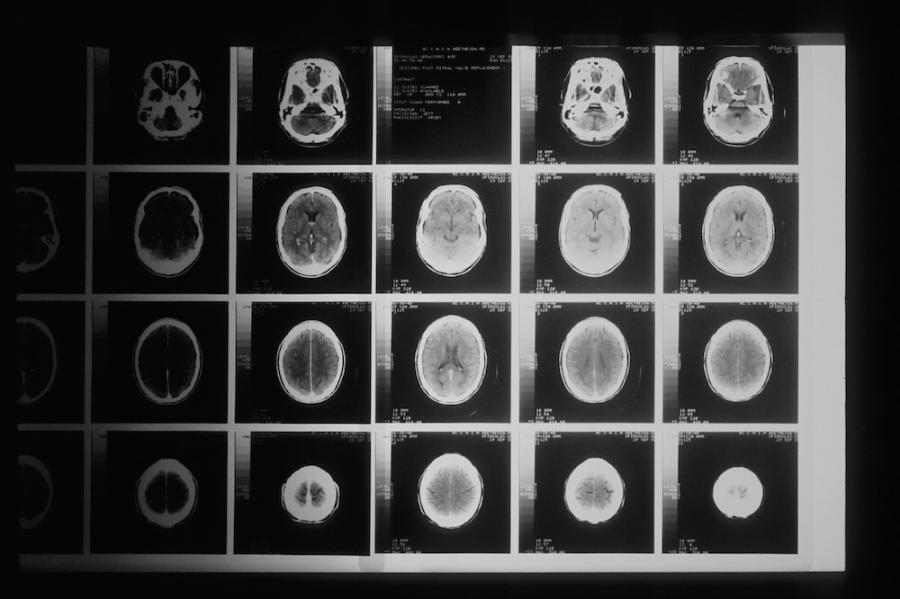 Grid of 20 black and white images of an oblong shape: a brain seen from above